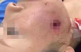 我总领馆就“中国游客在泰国脸部中弹”发布提醒，伤者女儿：母亲住院只能吃流食，伤口恢复还需3个月，将起诉索赔